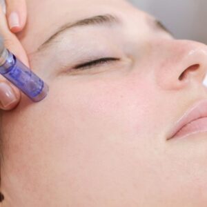 Mujer recibiendo dermapen