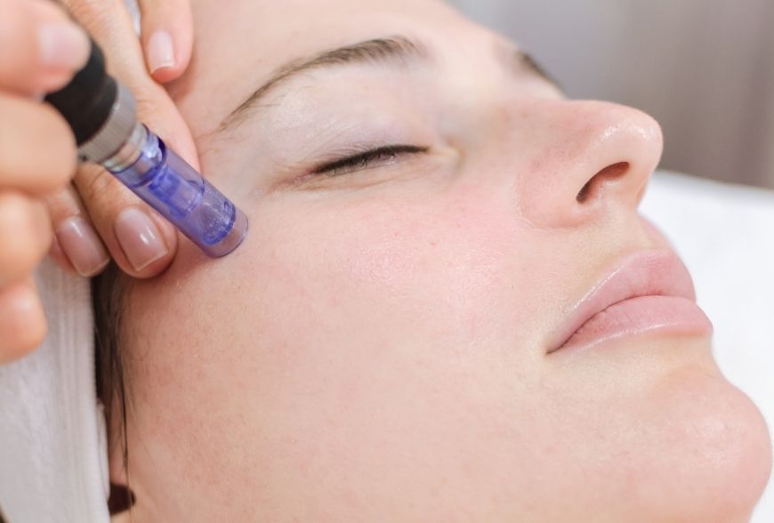 Mujer recibiendo dermapen